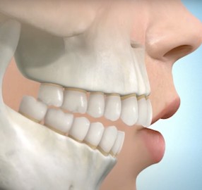 Avancement de la mandibule par chirurgie